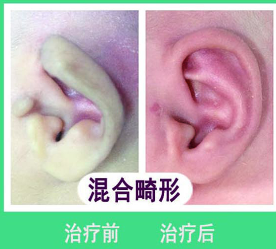 混合畸形