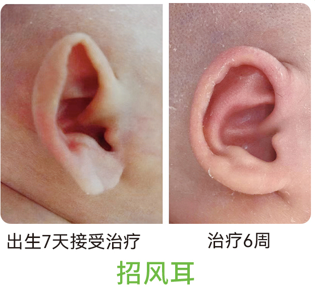 招风耳