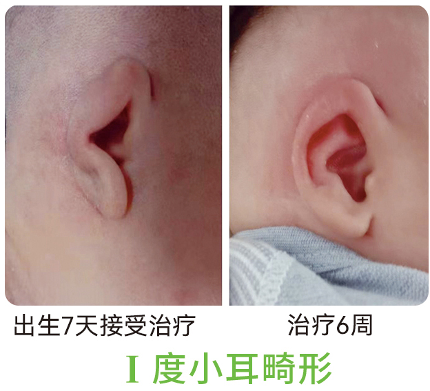 1度小耳畸形