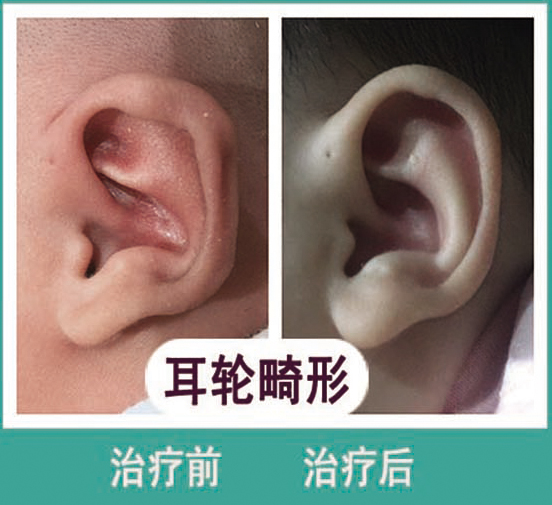 耳轮畸形